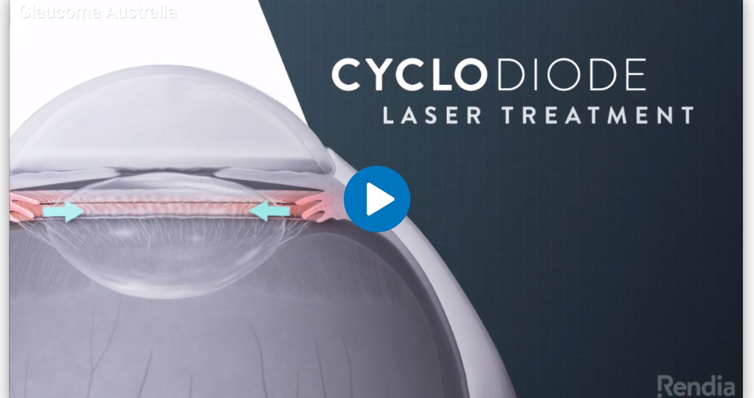 Laser Treatment Australia